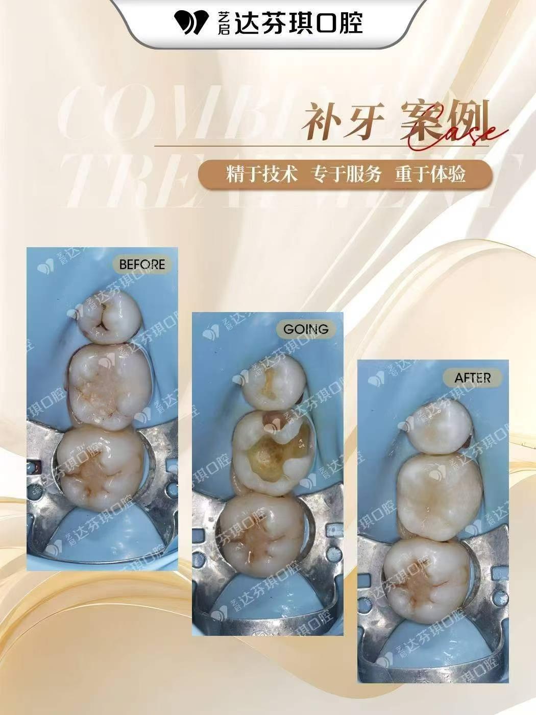 呼伦贝尔市树脂牙贴面怎么样