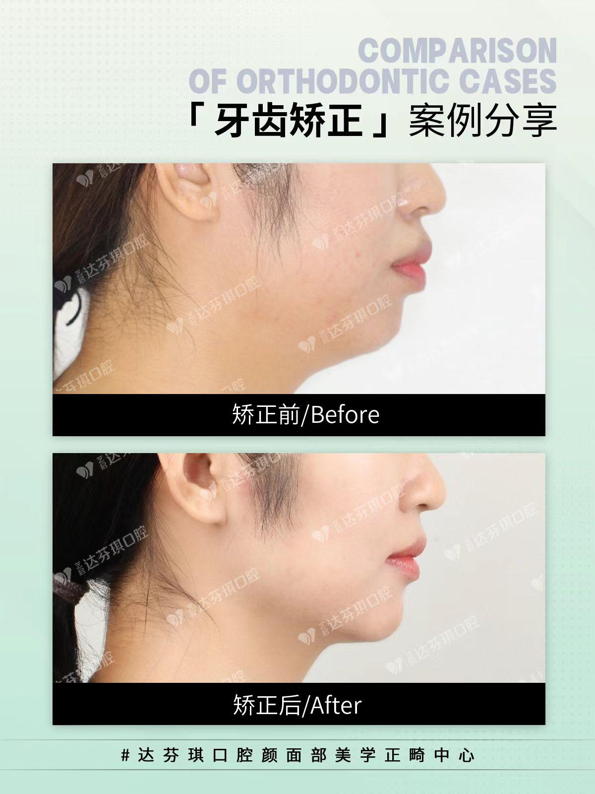 呼伦贝尔市牙树脂贴面哪家好