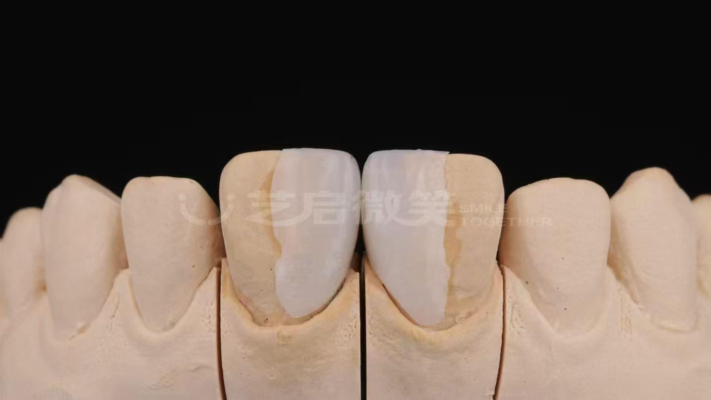 北塔区西安补蛀牙厂家