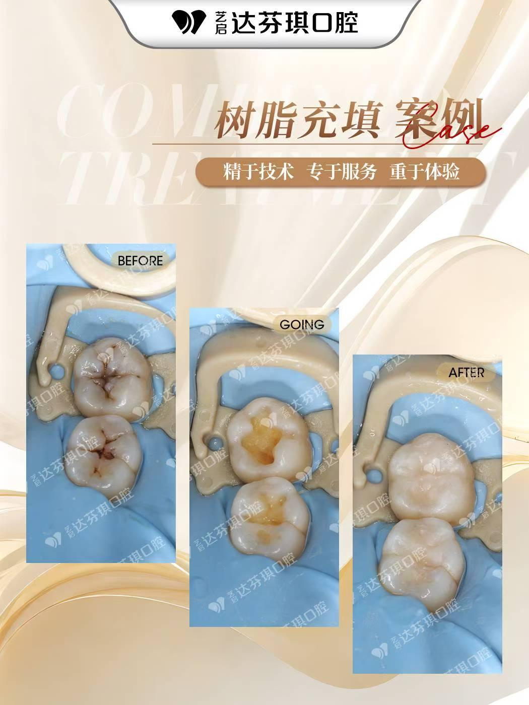 昌都市20岁矫正牙齿排名