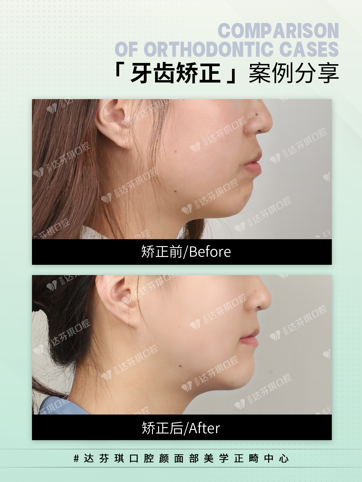 盐城市西安陶瓷托槽矫正价格