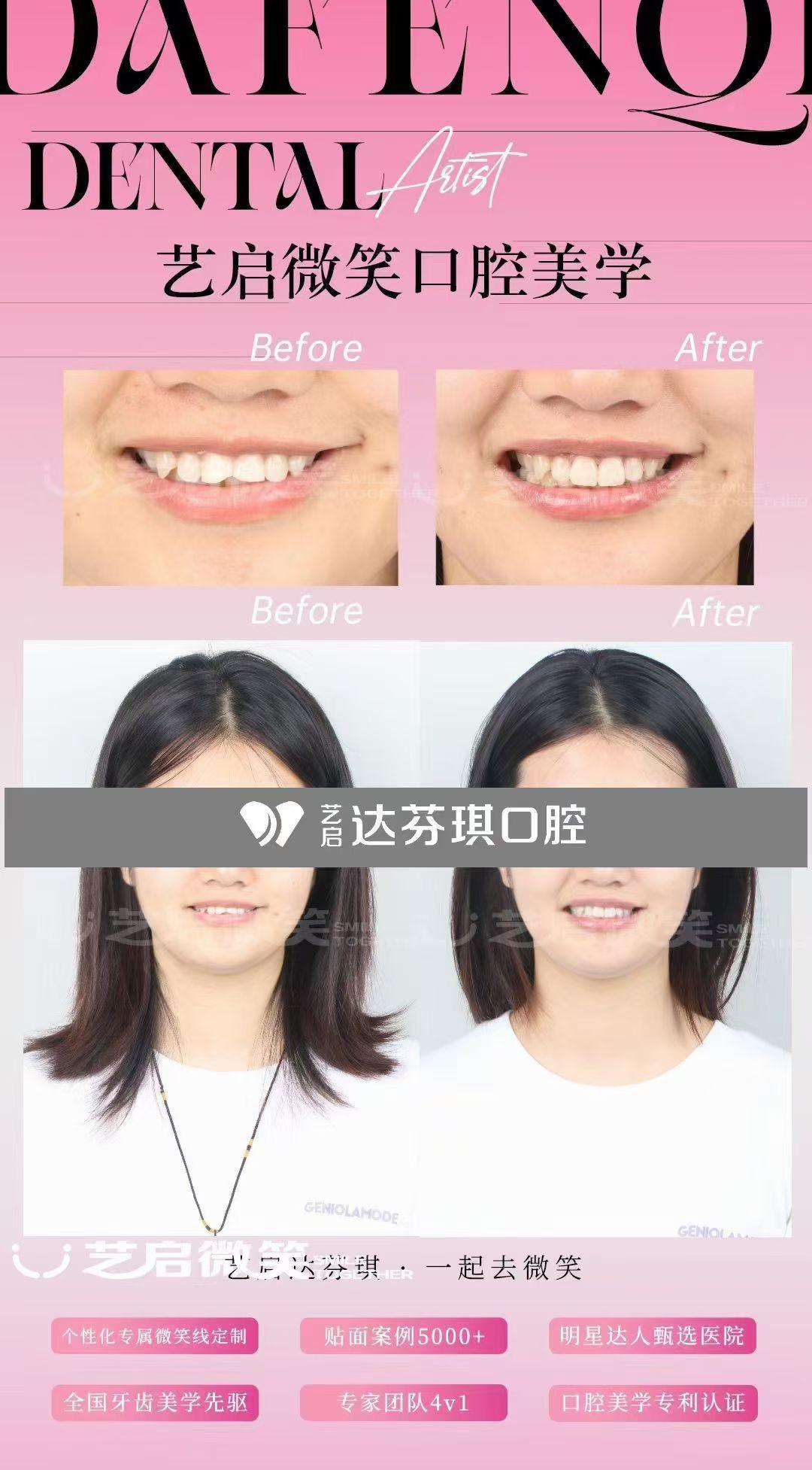 市北区牙齿冷光美白供应商