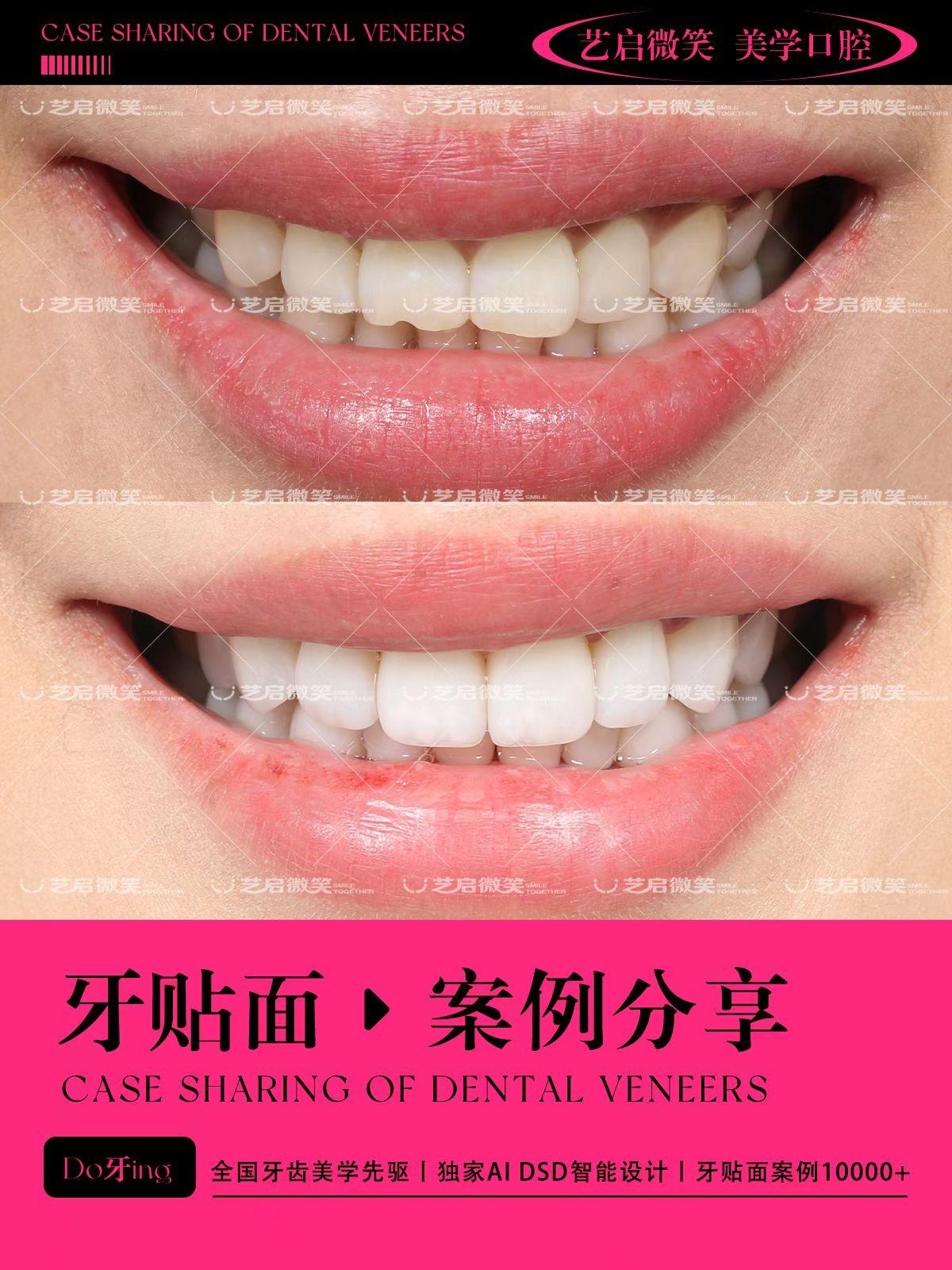 市北区做牙齿贴面推荐