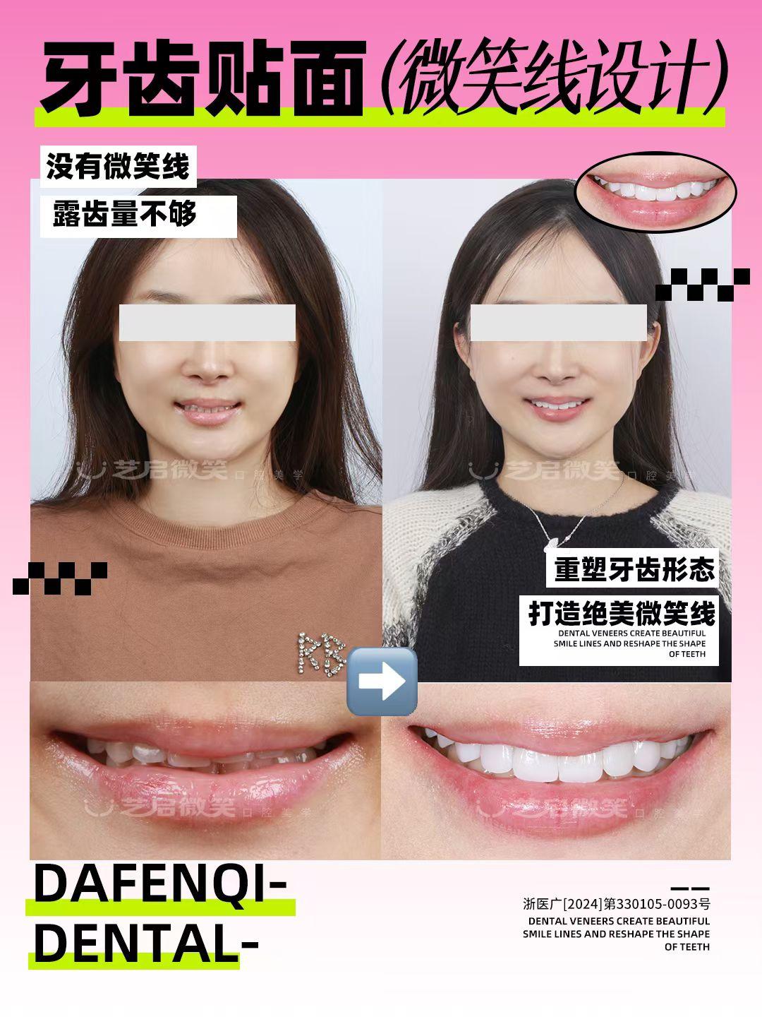市北区牙齿激光美白批发