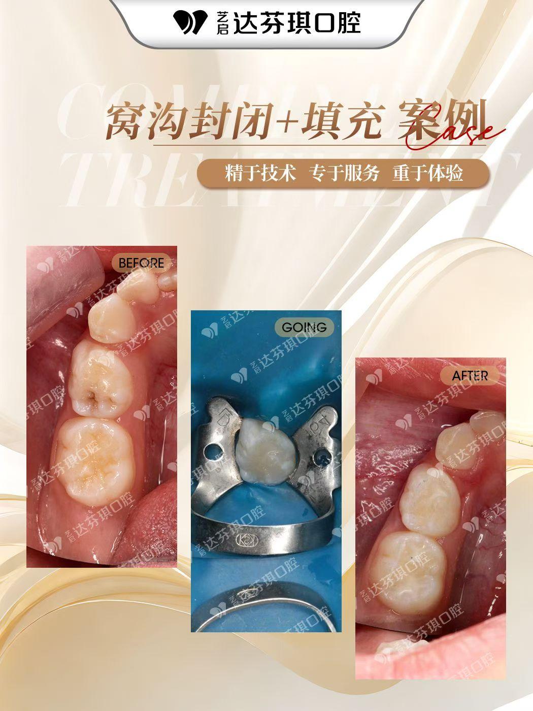 呼伦贝尔市超薄牙贴面供应商